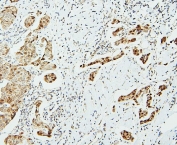 IHC staining of FFPE human breast cancer with UBC9 antibody. HIER: boil tissue sections in pH6, 10mM citrate buffer, for 20 min and allow to cool before testing.