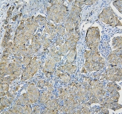 IHC staining of FFPE human breast cancer with RPL13A antibody. HIER: boil tissue sections in pH6, 10mM citrate buffer, for 20 min and allow to cool before testing.