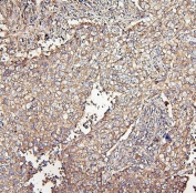 IHC staining of FFPE human lung cancer with MVP antibody. HIER: boil tissue sections in pH6, 10mM citrate buffer, for 20 min and allow to cool before testing.