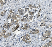 IHC staining of FFPE human breast cancer with Alpha 1 Catenin antibody. HIER: boil tissue sections in pH8 EDTA for 20 min and allow to cool before testing.