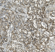 IHC staining of FFPE human stomach cancer with TXN2 antibody. HIER: boil tissue sections in pH8 EDTA for 20 min and allow to cool before testing.