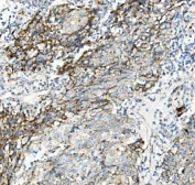 IHC staining of FFPE human lung cancer with TXN2 antibody. HIER: boil tissue sections in pH8 EDTA for 20 min and allow to cool before testing.