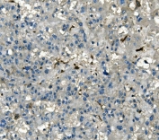 IHC staining of FFPE human liver cancer with AKR1D1 antibody. HIER: boil tissue sections in pH8 EDTA for 20 min and allow to cool before testing.