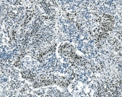 IHC staining of FFPE human lung cancer with Msi1 antibody. HIER: boil tissue sections in pH8 EDTA for 20 min and allow to cool before testing.