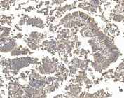IHC staining of FFPE human rectal cancer with Patched 2 antibody. HIER: boil tissue sections in pH8 EDTA for 20 min and allow to cool before testing.