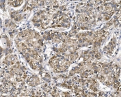 IHC staining of FFPE human liver cancer with Patched 2 antibody. HIER: boil tissue sections in pH8 EDTA for 20 min and allow to cool before testing.