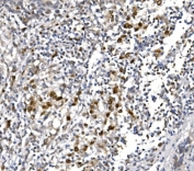IHC staining of FFPE human lung cancer with POLR2A antibody. HIER: boil tissue sections in pH8 EDTA for 20 min and allow to cool before testing.