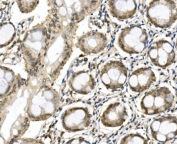 IHC staining of FFPE human breast cancer with AIP4 antibody. HIER: boil tissue sections in pH8 EDTA for 20 min and allow to cool before testing.