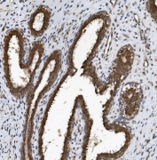 IHC staining of FFPE human breast cancer with BCRP antibody. HIER: boil tissue sections in pH8 EDTA for 20 min and allow to cool before testing.