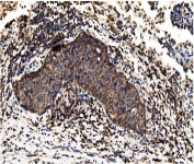 IHC staining of FFPE human lung cancer with ALPL antibody. HIER: boil tissue sections in pH8 EDTA for 20 min and allow to cool before testing.