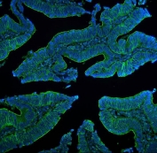 Immunofluorescent staining of FFPE human intestinal cancer with CLDN5 antibody (green) and DAPI nuclear stain (blue). HIER: steam section in pH8 EDTA for 20 min.