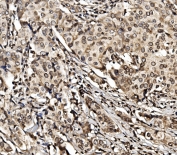 IHC staining of FFPE human breast cancer with HIF1A antibody. HIER: boil tissue sections in pH8 EDTA for 20 min and allow to cool before testing.