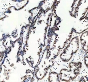 IHC staining of FFPE human ovarian cancer tissue with MSH6 antibody. HIER: boil tissue sections in pH8 EDTA for 20 min and allow to cool before testing.