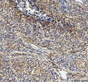 IHC staining of FFPE human lung cancer with NOX5 antibody. HIER: boil tissue sections in pH8 EDTA for 20 min and allow to cool before testing.