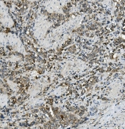 IHC staining of FFPE human gastric cancer with ABCC5 antibody. HIER: boil tissue sections in pH8 EDTA for 20 min and allow to cool before testing.