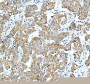 IHC staining of FFPE human liver cancer tissue with ACADSB antibody, HRP-secondary and DAB substrate. HIER: boil tissue sections in pH8 EDTA for 20 min and allow to cool before testing.