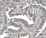 IHC staining of FFPE human rectal cancer with PDE6 alpha antibody. HIER: boil tissue sections in pH8 EDTA for 20 min and allow to cool before testing.