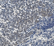 IHC staining of FFPE human lung cancer with AHR antibody. HIER: boil tissue sections in pH8 EDTA for 20 min and allow to cool before testing.