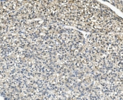 IHC staining of FFPE human liver cancer with AKR1D1 antibody. HIER: boil tissue sections in pH8 EDTA for 20 min and allow to cool before testing.
