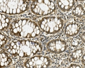 IHC staining of FFPE human rectal cancer with HGS antibody. HIER: boil tissue sections in pH8 EDTA for 20 min and allow to cool before testing.