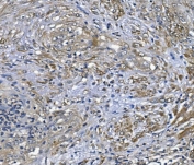 IHC staining of FFPE human endometrial carcinoma cancer with Peroxiredoxin 6 antibody. HIER: boil tissue sections in pH8 EDTA for 20 min and allow to cool before testing.