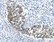 IHC staining of FFPE human lung cancer with Keratin 18 antibody. HIER: boil tissue sections in pH8 EDTA for 20 min and allow to cool before testing.