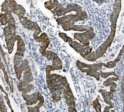 IHC staining of FFPE human rectal cancer with Keratin 18 antibody. HIER: boil tissue sections in pH8 EDTA for 20 min and allow to cool before testing.