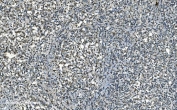 IHC staining of FFPE human gastric cancer with LSM8 antibody. HIER: boil tissue sections in pH8 EDTA for 20 min and allow to cool before testing.