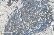 IHC staining of FFPE human ovarian cancer with TIMM8A antibody. HIER: boil tissue sections in pH8 EDTA for 20 min and allow to cool before testing.