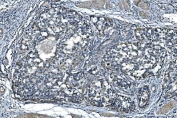 IHC staining of FFPE human bladder cancer with TIMM8A antibody. HIER: boil tissue sections in pH8 EDTA for 20 min and allow to cool before testing.