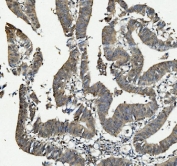 IHC staining of FFPE human rectal cancer with ANAPC2 antibody. HIER: boil tissue sections in pH8 EDTA for 20 min and allow to cool before testing.