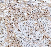 IHC staining of FFPE human bladder urothelial carcinoma tissue with CDK12 antibody. HIER: boil tissue sections in pH8 EDTA for 20 min and allow to cool before testing.