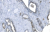 IHC staining of FFPE human prostate cancer with GCHFR antibody. HIER: boil tissue sections in pH8 EDTA for 20 min and allow to cool before testing.