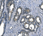 IHC staining of FFPE human colon cancer with Argininosuccinate Synthetase 1 antibody. HIER: boil tissue sections in pH8 EDTA for 20 min and allow to cool before testing.