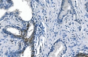 IHC staining of FFPE human prostate cancer with ASS1 antibody. HIER: boil tissue sections in pH8 EDTA for 20 min and allow to cool before testing.