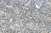 IHC staining of FFPE human liver cancer with ASS1 antibody. HIER: boil tissue sections in pH8 EDTA for 20 min and allow to cool before testing.