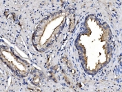 IHC staining of FFPE human prostate cancer with ANPEP antibody. HIER: boil tissue sections in pH8 EDTA for 20 min and allow to cool before testing.