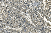 IHC staining of FFPE human liver cancer with ANPEP antibody. HIER: boil tissue sections in pH8 EDTA for 20 min and allow to cool before testing.