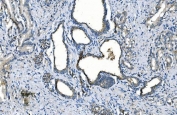 IHC staining of FFPE human prostate cancer with Carbonic Anhydrase I antibody. HIER: boil tissue sections in pH8 EDTA for 20 min and allow to cool before testing.
