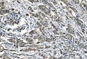 IHC staining of FFPE human breast cancer with Carbonic Anhydrase I antibody. HIER: boil tissue sections in pH8 EDTA for 20 min and allow to cool before testing.