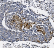 IHC staining of FFPE human lung cancer with AFAP1 antibody. HIER: boil tissue sections in pH8 EDTA for 20 min and allow to cool before testing.