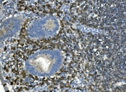 IHC staining of FFPE human appendicitis tissue with CD20 antibody. HIER: boil tissue sections in pH8 EDTA for 20 min and allow to cool before testing.