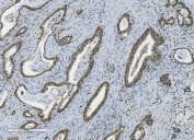 IHC staining of FFPE human gallbladder adenocarcinoma with PARP antibody. HIER: boil tissue sections in pH8 EDTA for 20 min and allow to cool before testing.