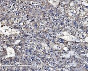 IHC staining of FFPE human liver cancer with ABCB1 antibody. HIER: boil tissue sections in pH8 EDTA for 20 min and allow to cool before testing.