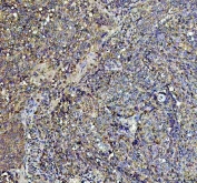 IHC staining of FFPE human cervical carcinoma tissue with Argonaute 3 antibody. HIER: boil tissue sections in pH8 EDTA for 20 min and allow to cool before testing.
