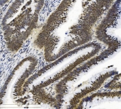 IHC staining of FFPE human low-differentiated adenocarcinoma with SMAD2 antibody. HIER: boil tissue sections in pH8 EDTA for 20 min and allow to cool before testing.