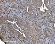 IHC staining of FFPE human gallbladder adenocarcinoma tissue with Prohibitin 2 antibody. HIER: boil tissue sections in pH8 EDTA for 20 min and allow to cool before testing.
