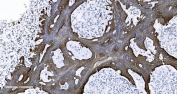 IHC staining of FFPE human ovarian cancer with EPRS antibody. HIER: boil tissue sections in pH8 EDTA for 20 min and allow to cool before testing.