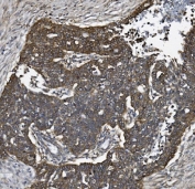 IHC staining of FFPE human ovarian serous adenocarcinoma tissue with ACVRL1 antibody. HIER: boil tissue sections in pH8 EDTA for 20 min and allow to cool before testing.
