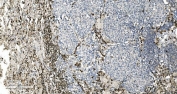 IHC staining of FFPE human lung cancer tissue with Coronin 1a antibody. HIER: boil tissue sections in pH8 EDTA for 20 min and allow to cool before testing.